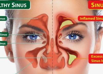 برای سینوزیت چه زمانی باید به دکتر مراجعه کنیم؟